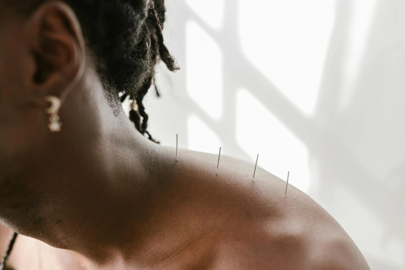 Dry Needling vs. Acupuncture: What Is the Difference and Which Works for Pain?